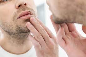 What are the Symptoms of Genital Herpes