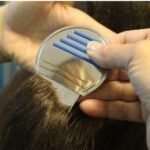 Head Lice