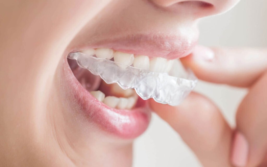 3 Tips on How to Get Perfect Invisalign Braces