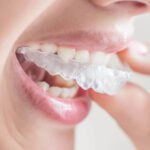 3 Tips on How to Get Perfect Invisalign Braces