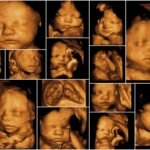 An Introduction To 3D Ultrasound And 4D Ultrasound