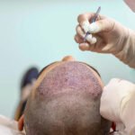 Hair transplant