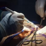 Reduction Mammaplasty: Everything You Need To Know